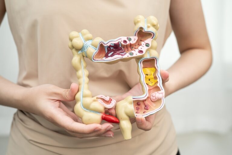 April: Leaky gut – eine Mode-Diagnose?